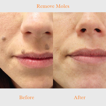 TruSkin Blemish Remover Serum