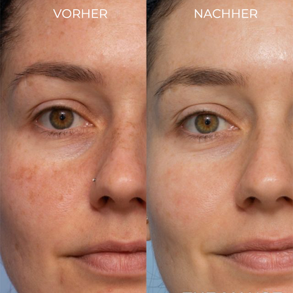 Spot-Off™ Aufhellungscreme für Sommersprossen