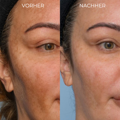 Spot-Off™ Aufhellungscreme für Sommersprossen