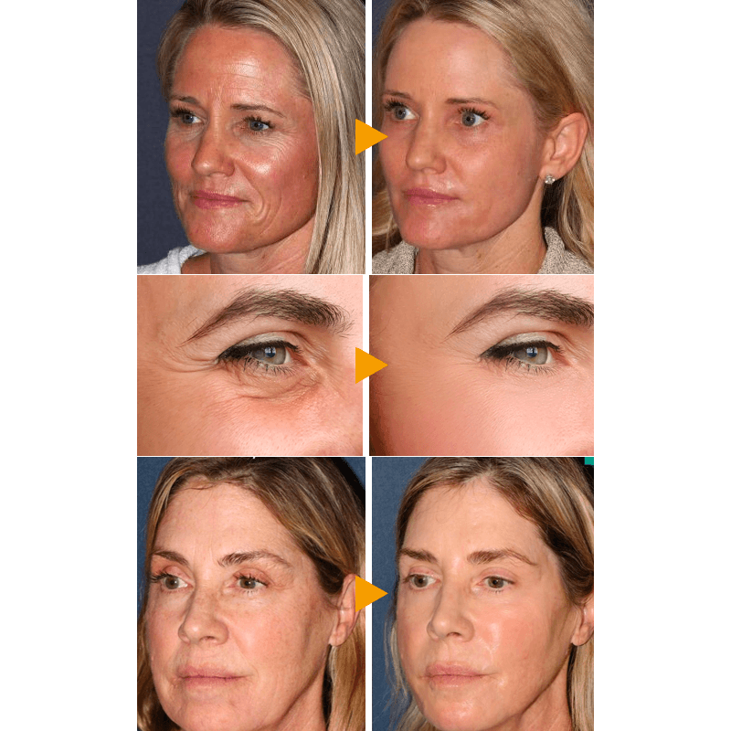 SkinPro Japanese Silk Collagen Ball